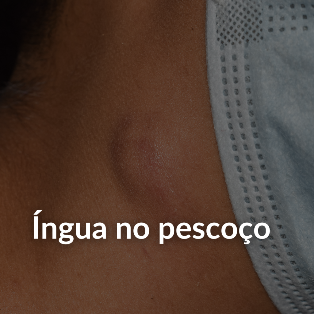íngua no pescoço