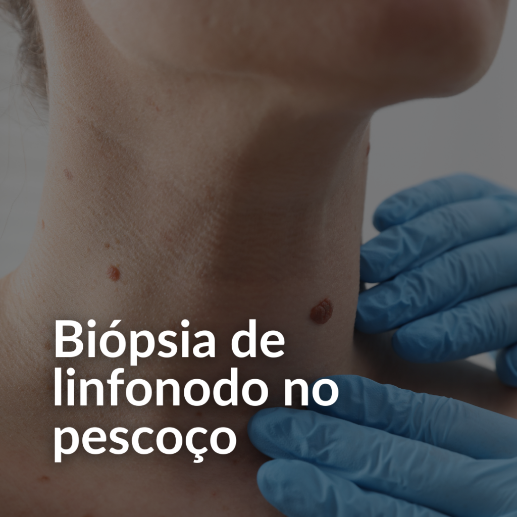 biópsia linfonodal pescoço