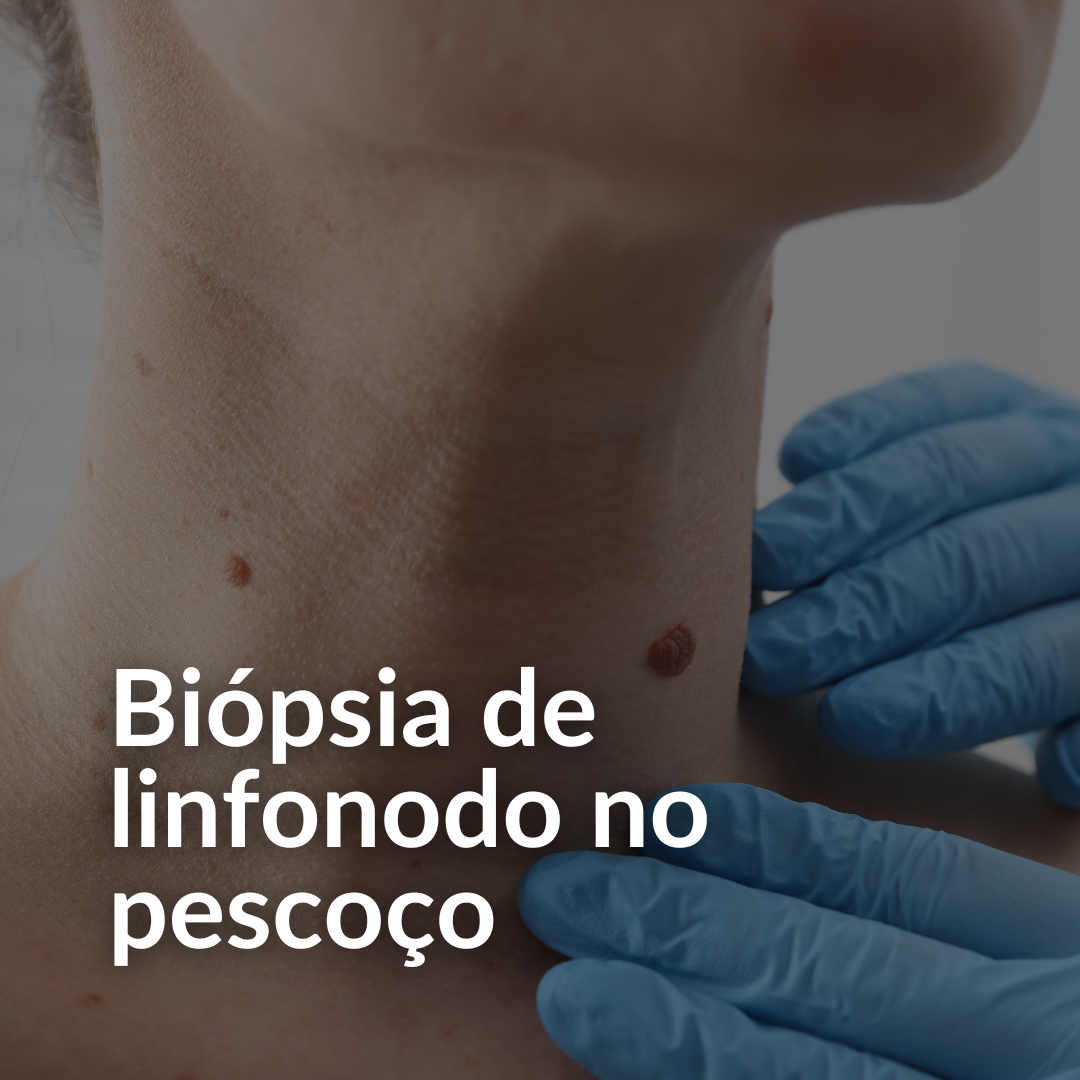 biópsia linfonodal pescoço