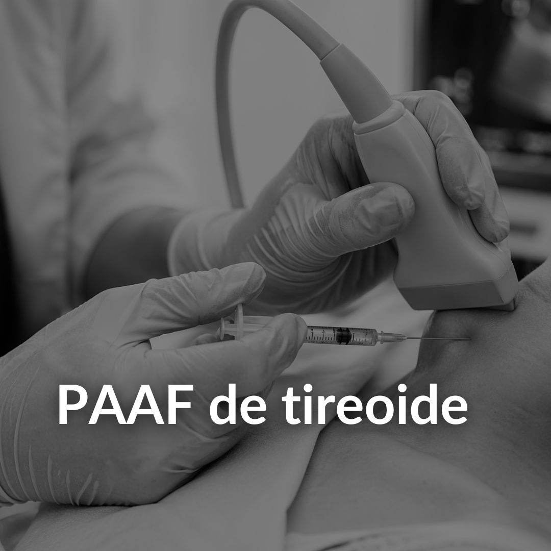 PAAF de tireoide