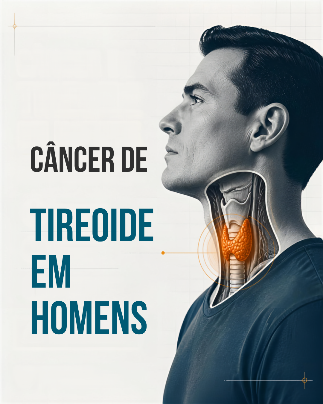 câncer de tireoide em homens tireoidectomia parcial