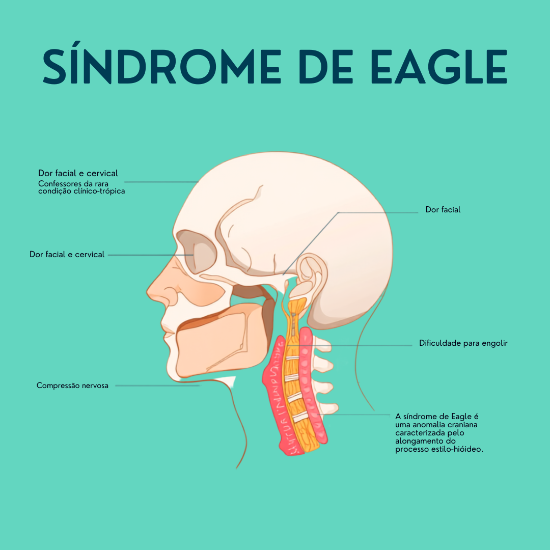 síndrome de Eagle